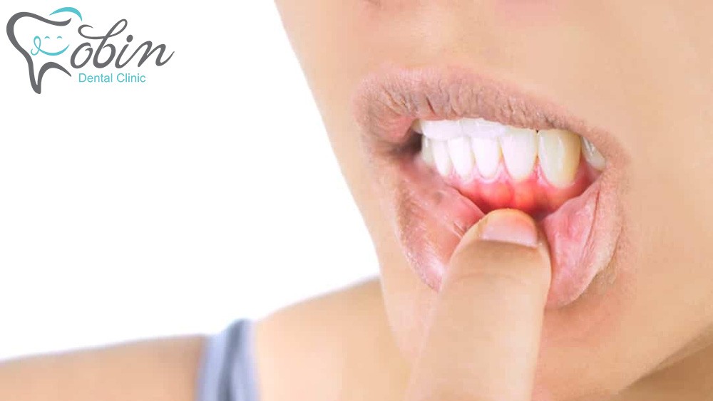افتادن کامپوزیت دندان ممکن است به دلیل عفونت لثه اتفاق بیفتد.